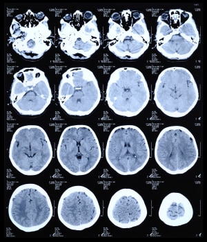 CT scan of the human brain. CT scan of the human brain.